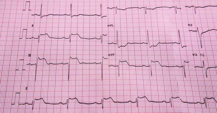 ECG - STEMI - signes d'élévation du segment ST et infarctus du muscle cardiaque