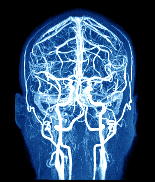 IRM du cerveau et des vaisseaux cérébraux