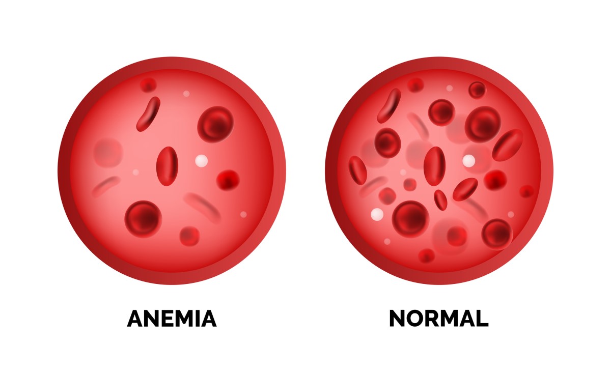 Anémie et taux normal de globules rouges dans le sang