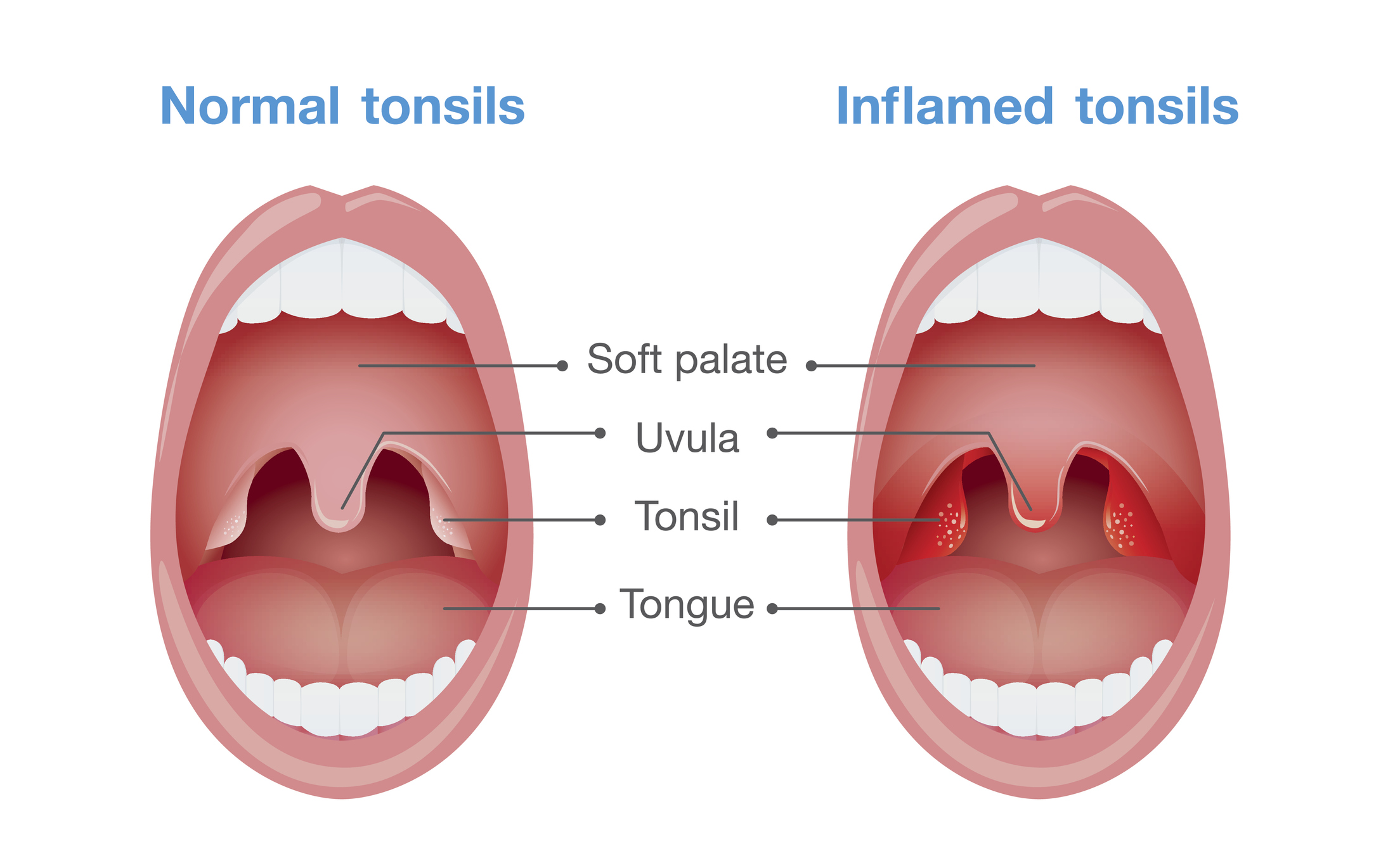 Angine - inflammation des amygdales