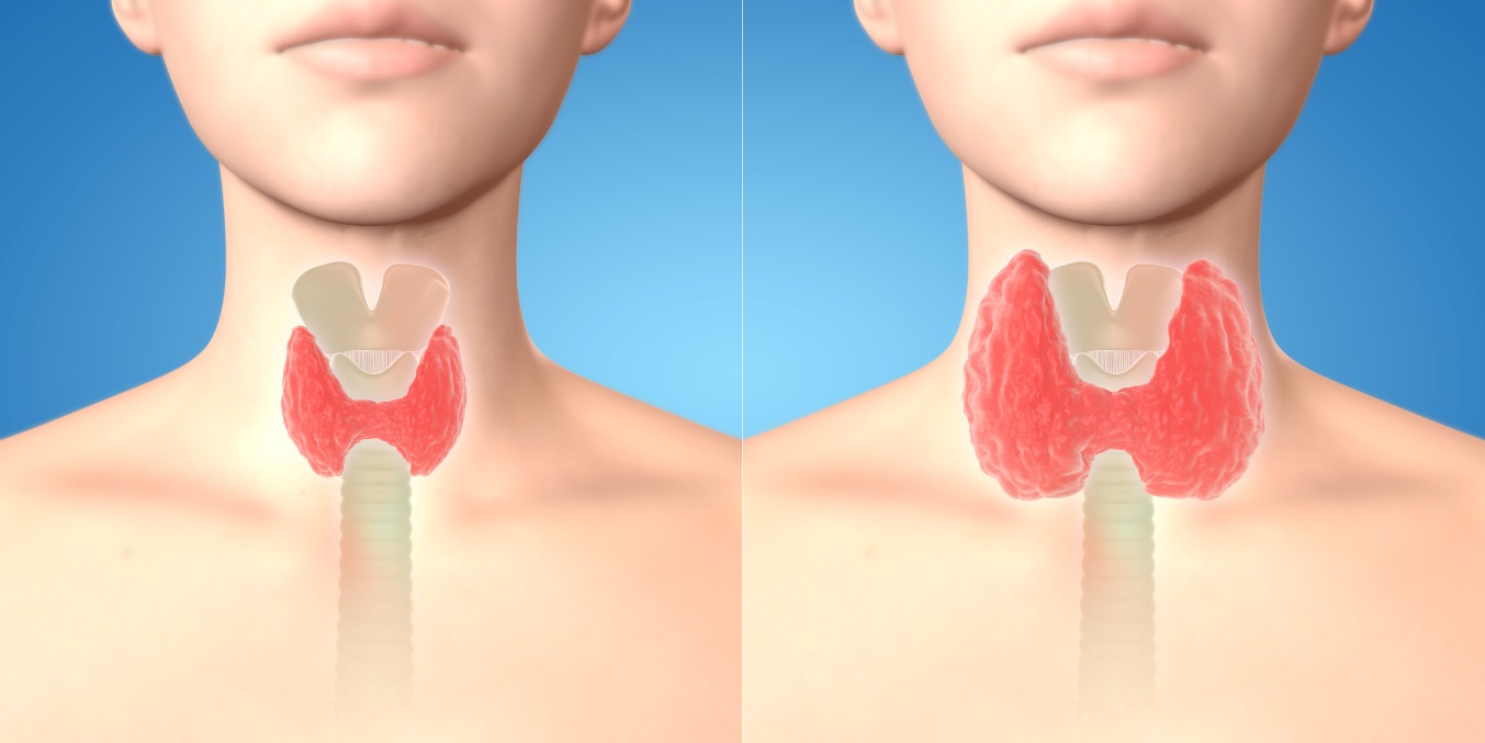 Aspect et palpation d'une glande thyroïde hypertrophiée - goitre