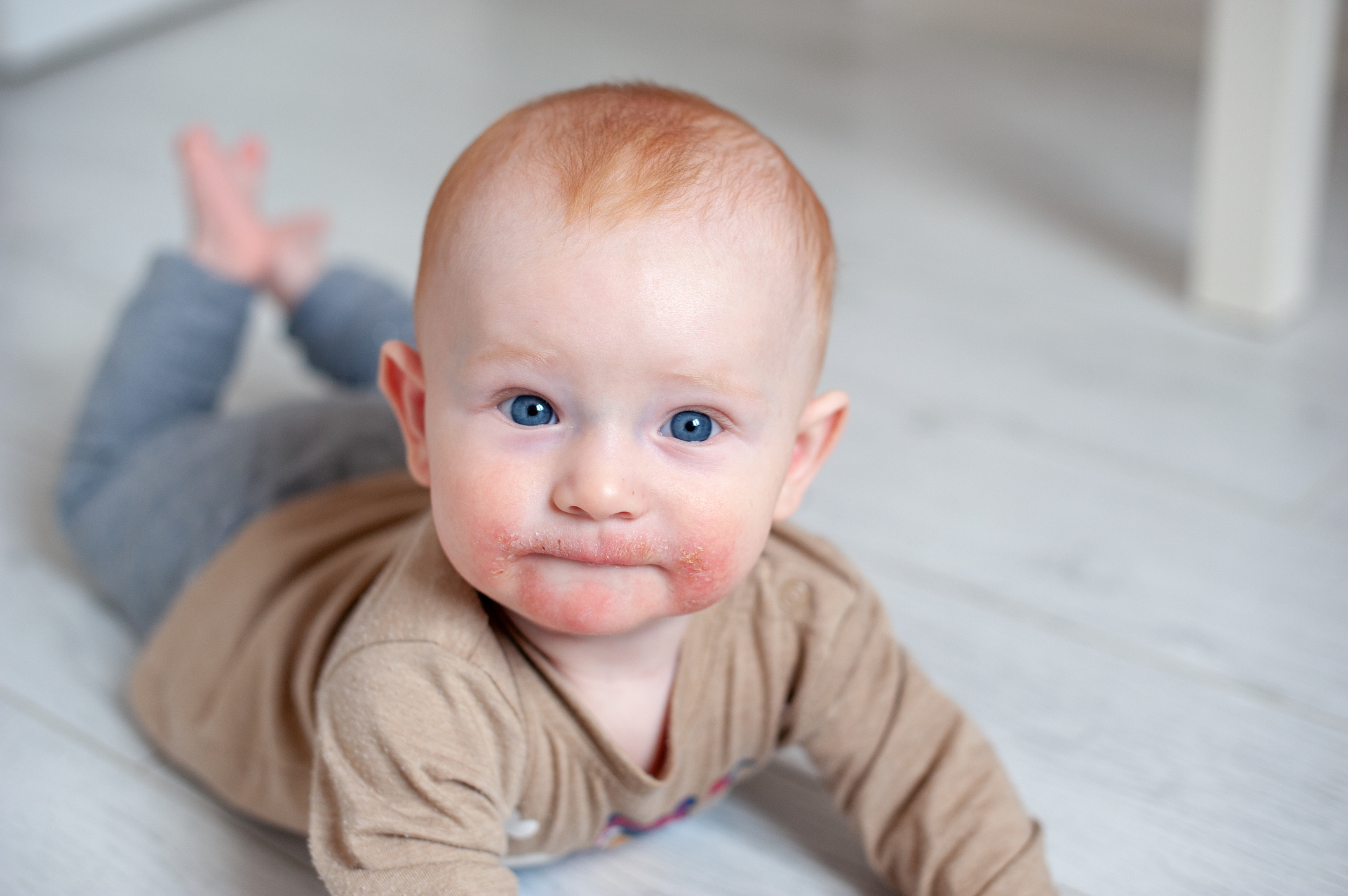 Dermatite atopique sur le visage de l'enfant