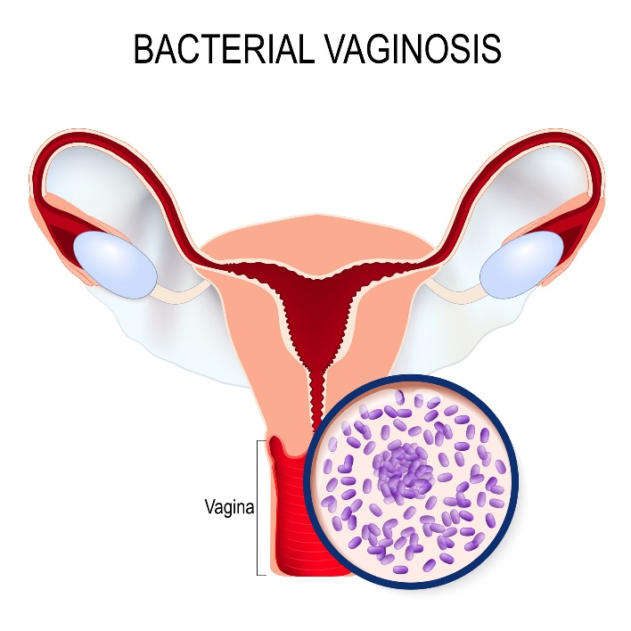 Vaginose bactérienne et prolifération de Gardnerella vaginalis