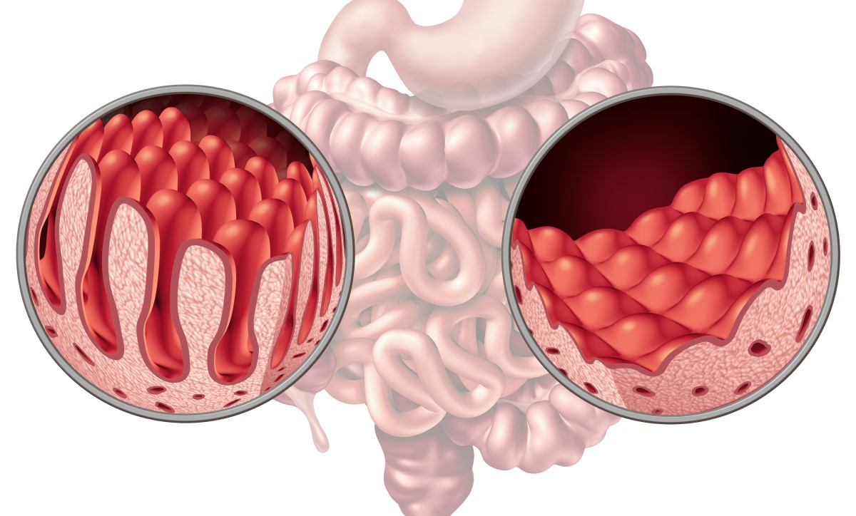 Comparaison de l'intestin et des villosités, où les nutriments sont absorbés : sains et endommagés par la maladie cœliaque