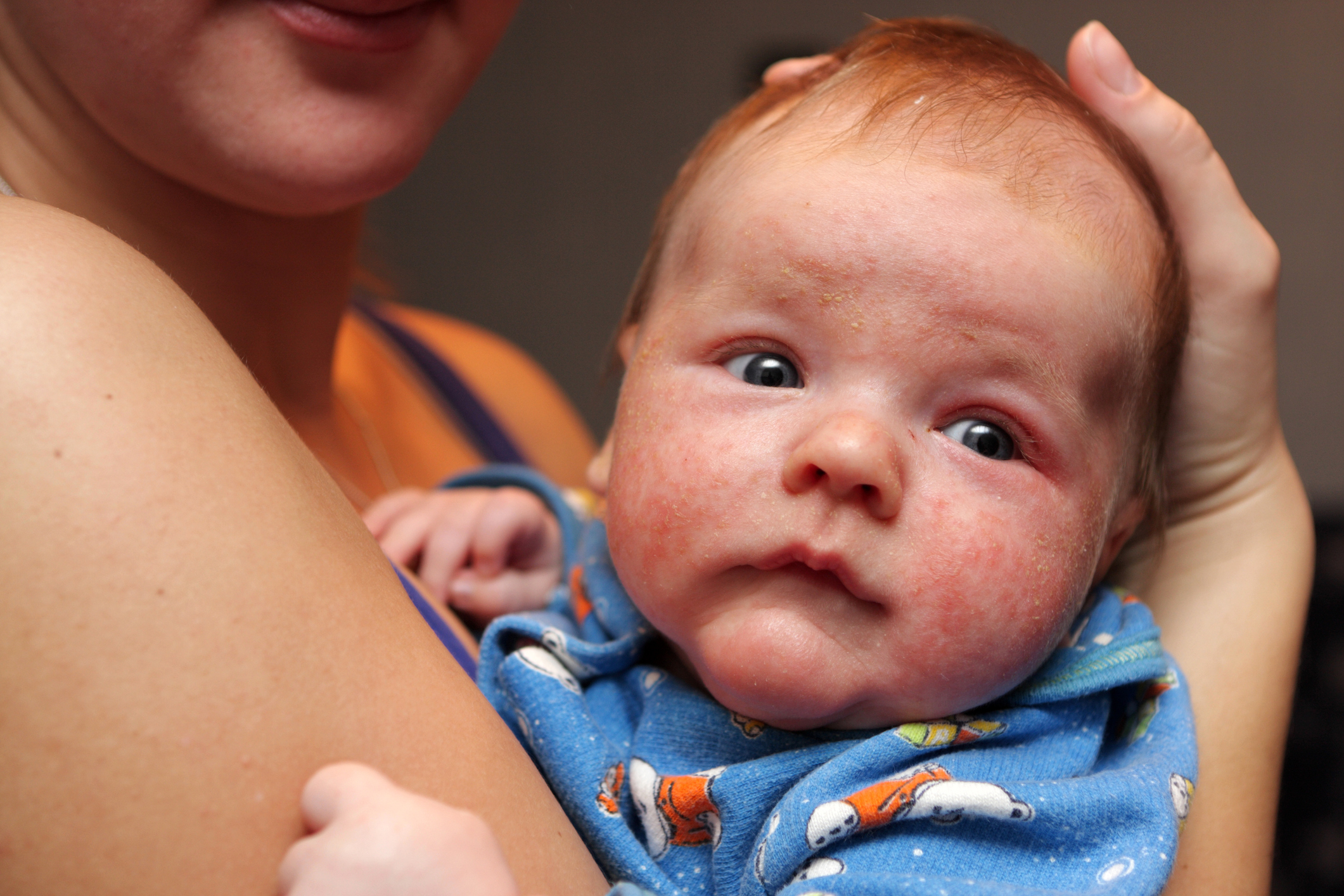 Dermatite sur le visage d'un petit enfant