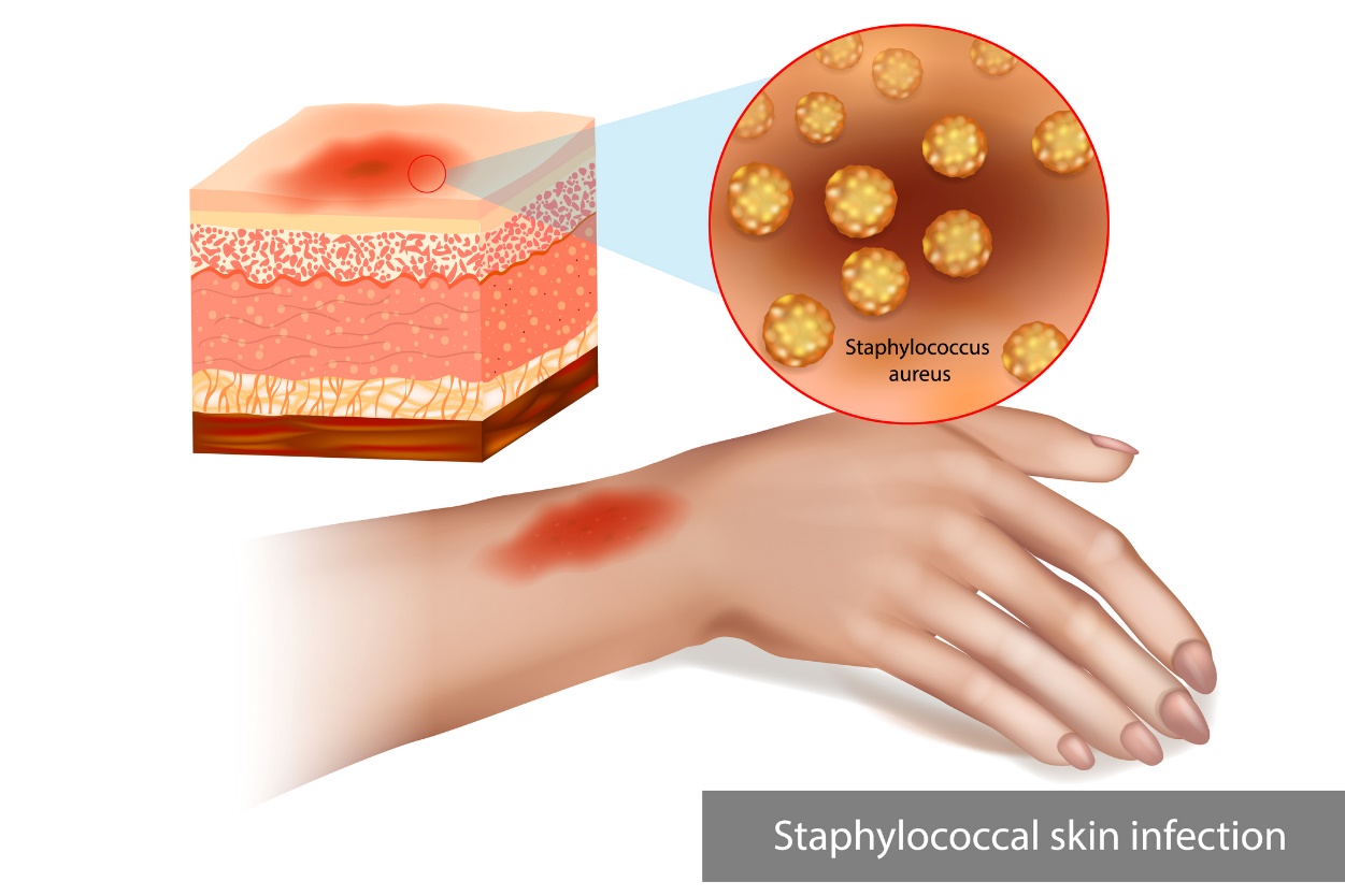 Infection cutanée staphylococcique