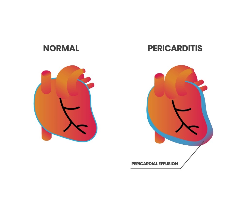 Physiologie cardiaque et péricardite (épanchement péricardique)