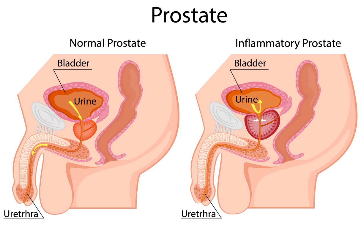 A gauche : prostate physiologique. A droite : prostate hypertrophiée. Située sous la vessie. Vessie, urine, urètre.