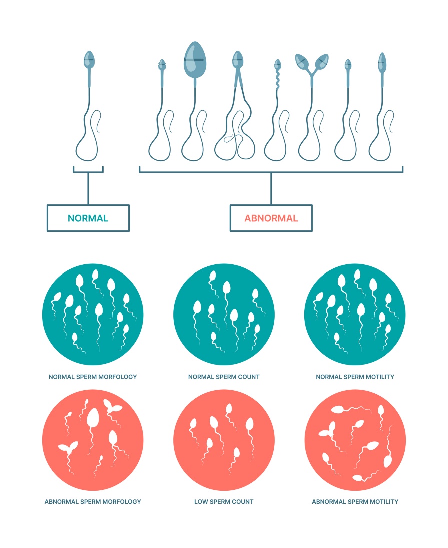 État physiologique et anormal des spermatozoïdes. Morphologie, nombre et mobilité des spermatozoïdes.