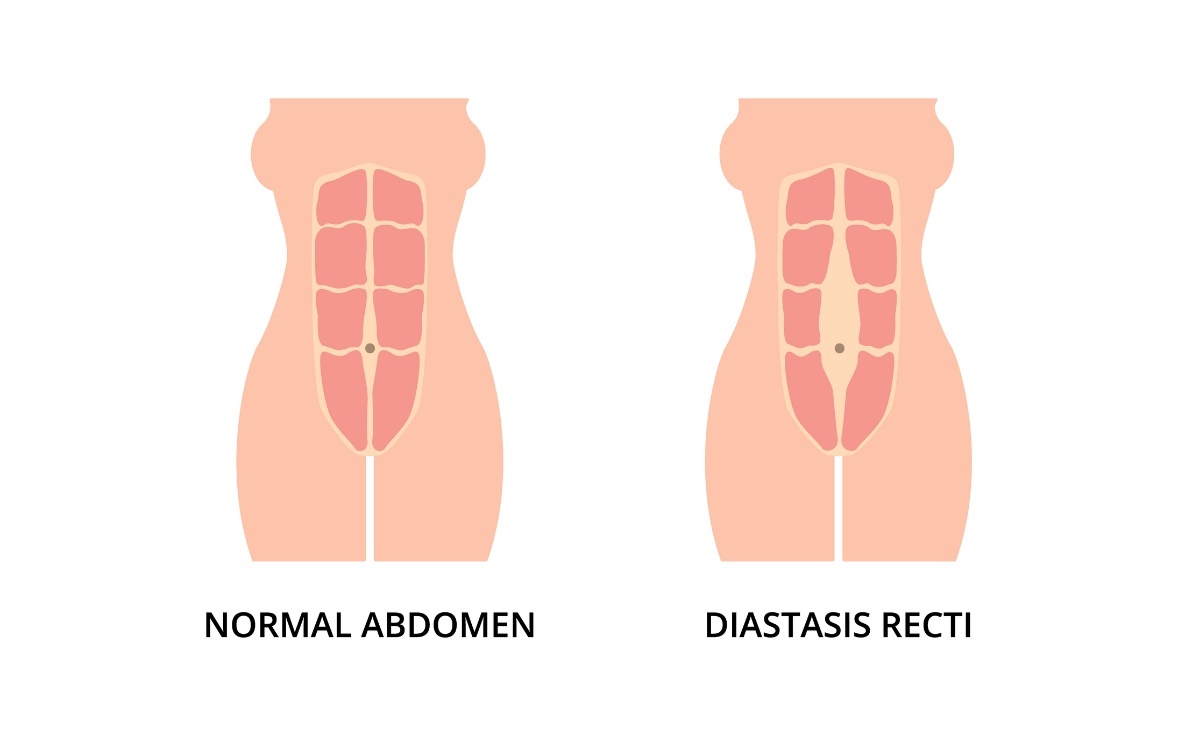 État physiologique des muscles abdominaux et diastase (espacement) des muscles grands droits gauche et droit de l'abdomen par rapport à la ligne médiane de la ligne blanche.