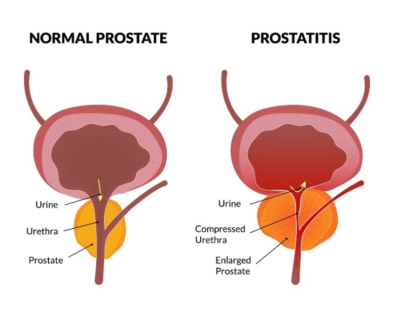 L'état physiologique de la prostate et la prostatite