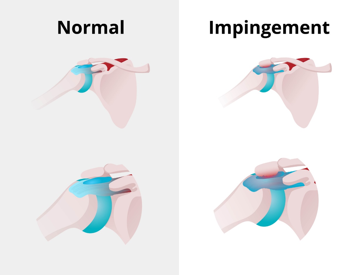 État physiologique de l'articulation de l'épaule et syndrome de l'impingement