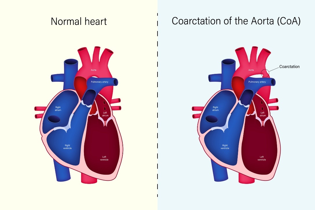 État physiologique du cœur et coarctation de l'aorte (CoA)