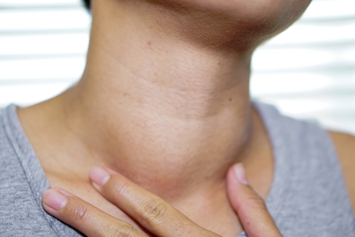 L'état physiologique de la glande thyroïde et le stade palpable et visible du goitre - hypertrophie de la glande thyroïde.