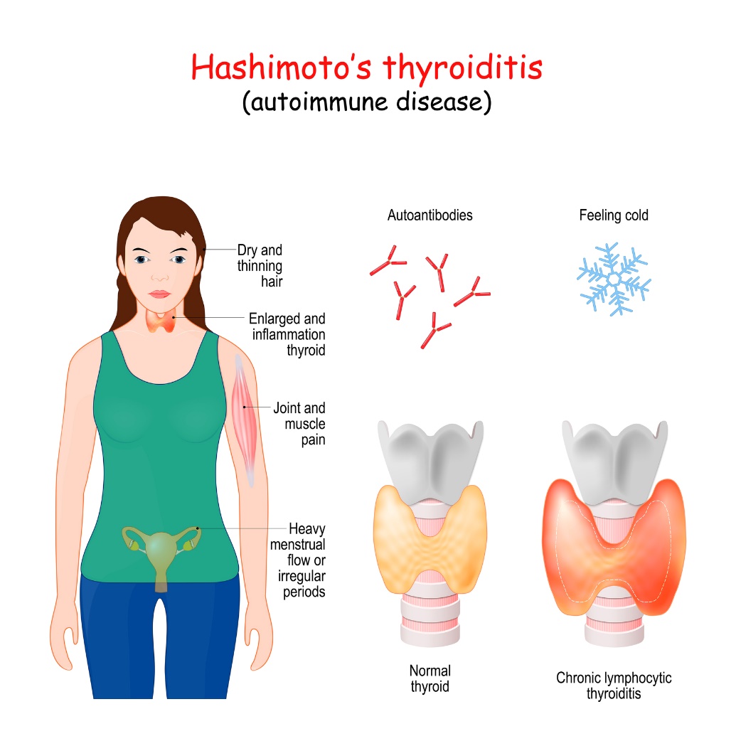 Thyroïdite de Hashimoto et symptômes cliniques