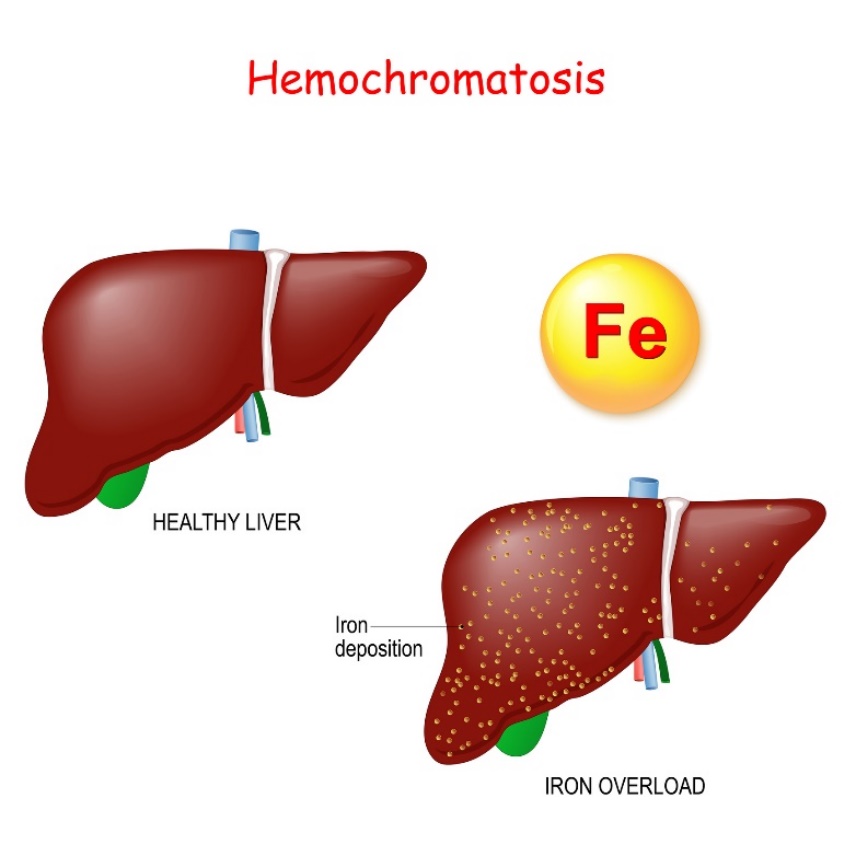 Hémochromatose : physiologie et pathologie du foie avec dépôt excessif de fer (Fe)