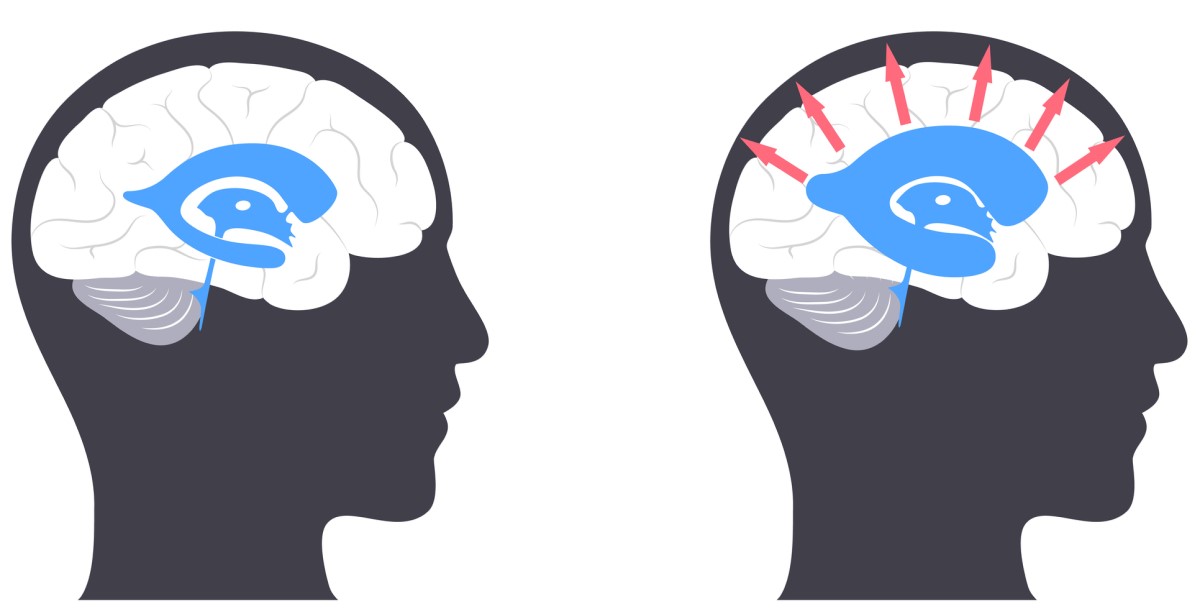 Tête avec cerveau - à gauche - cerveau normal / à droite - tête avec cerveau atteint d'hydrocéphalie, où les flèches du centre vers l'extérieur indiquent l'élargissement des ventricules cérébraux et la pression sur le tissu cérébral.