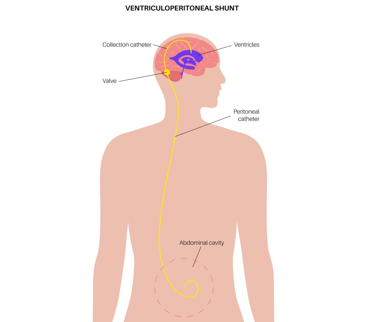 Illustration d'une dérivation ventriculo-abdominale qui draine l'excès de liquide du cerveau dans la cavité abdominale.