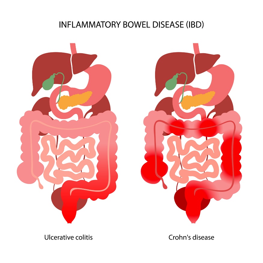 MICI : division en colite ulcéreuse et maladie de Crohn selon la localisation de la réaction inflammatoire.