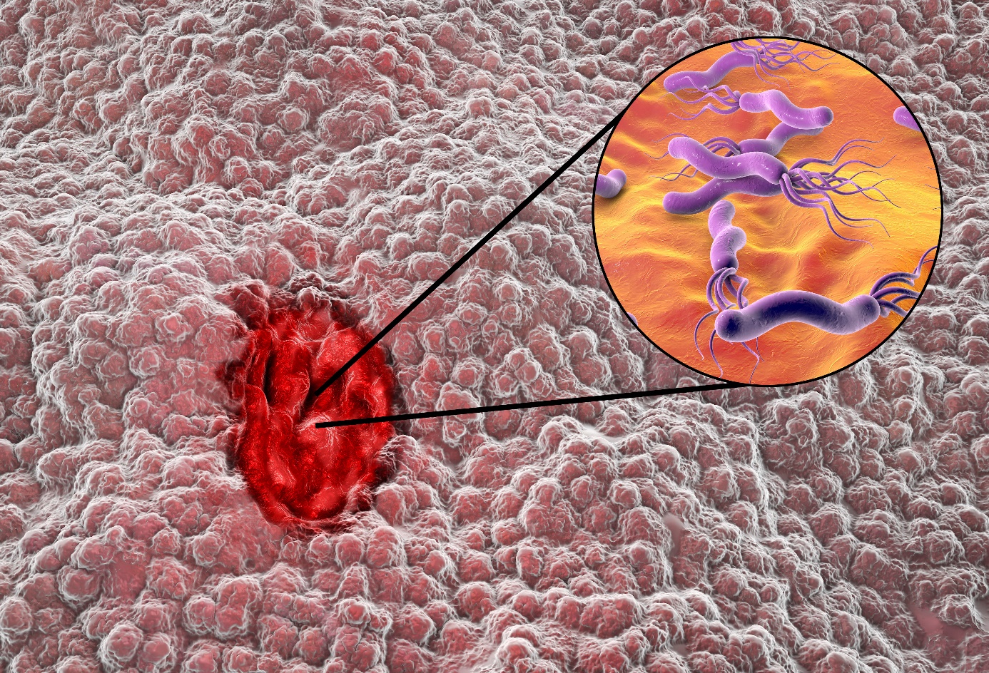 Infection à Helicobacter pylori