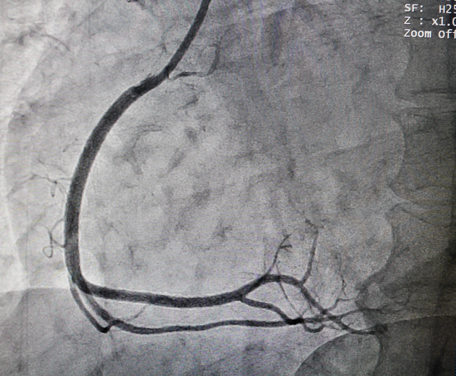 Coronarographie - coronaire ou vaisseau cardiaque