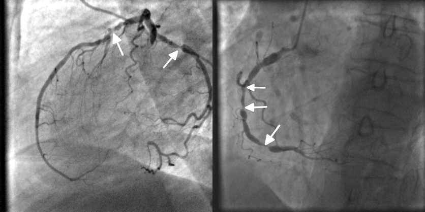 Coronarographie, angiographie, blocage de l'artère coronaire