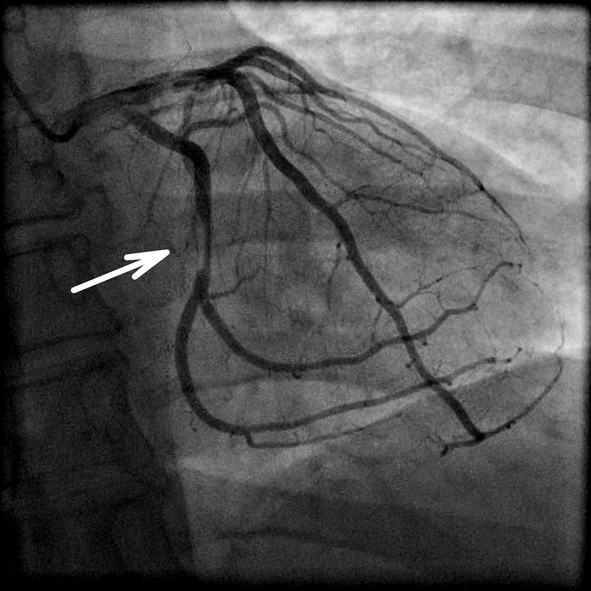 Coronarographie et rétrécissement de l'artère cardiaque