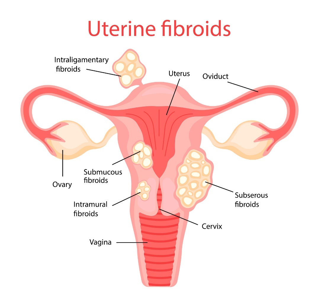 fibromes utérins