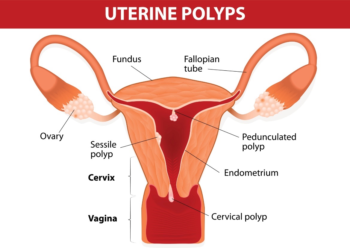 Polypes utérins