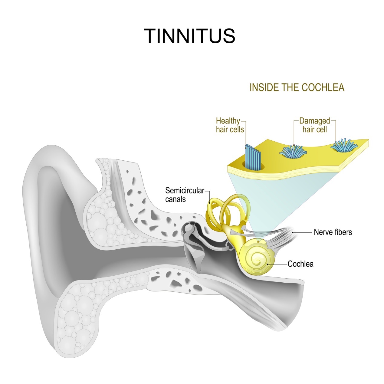 Oreille interne et acouphènes - sifflements et bourdonnements d'oreille