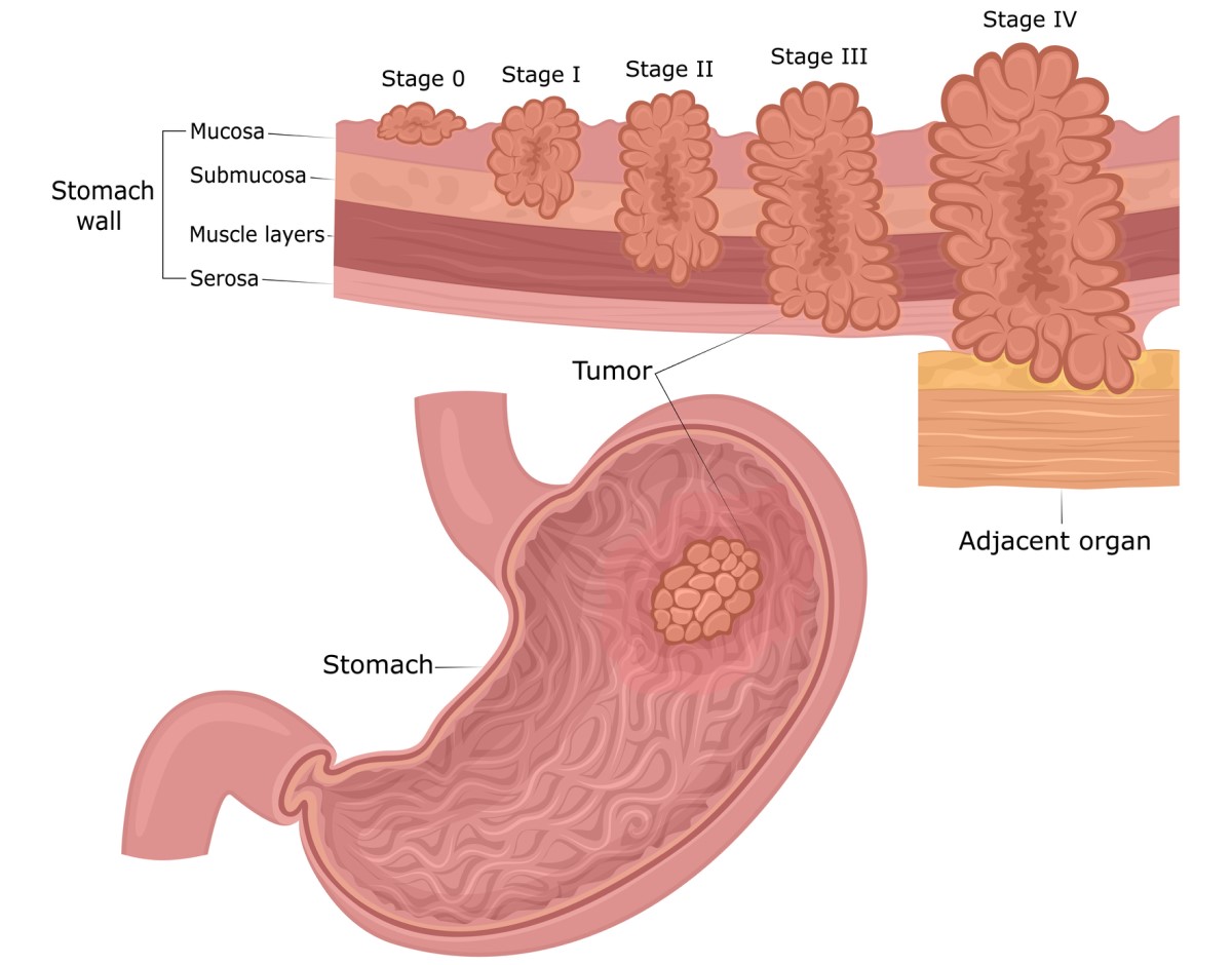 Cancer gastrique : les couches de la paroi de l'estomac (muqueuse, sous-muqueuse, muscle, séreuse) et les stades de développement de la tumeur, de la muqueuse à l'environnement et aux organes.