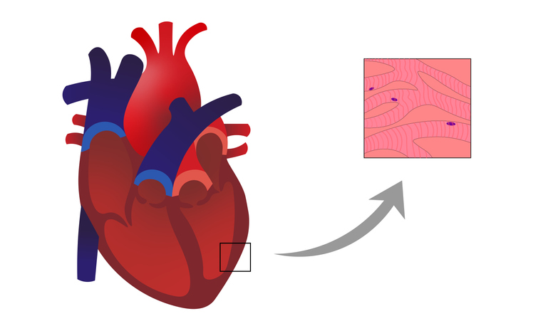 Myocardite : processus inflammatoire avec infiltration et dégénérescence des cardiomyocytes dans la paroi du muscle cardiaque.