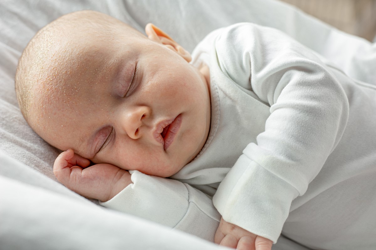 Un petit enfant, nouveau-né, endormi, présentant une séborrhée et des squames sur la tête.