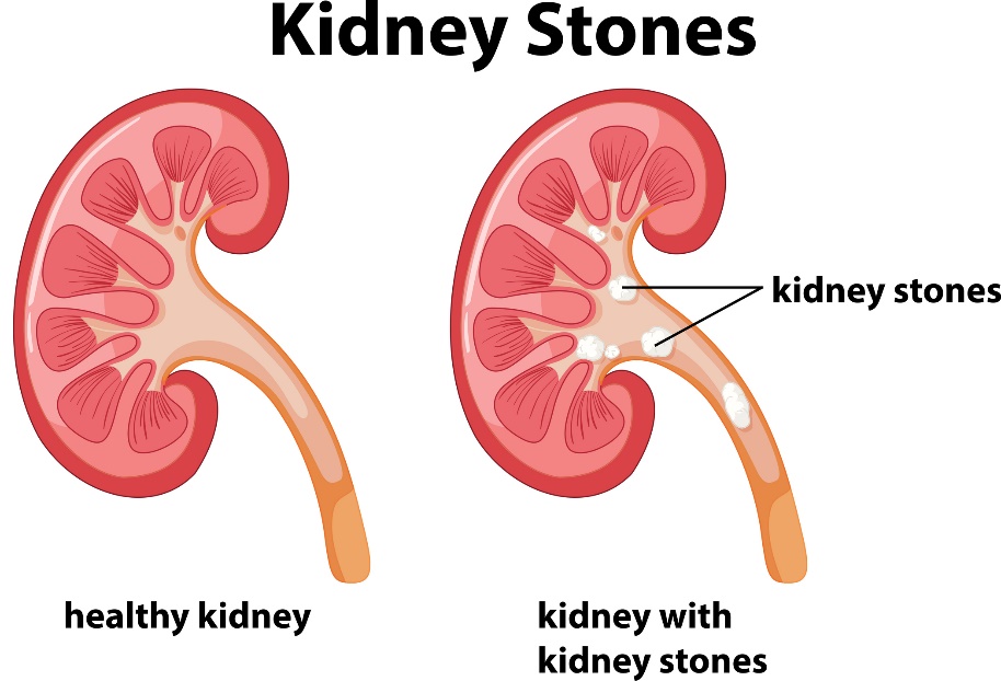 Calculs rénaux