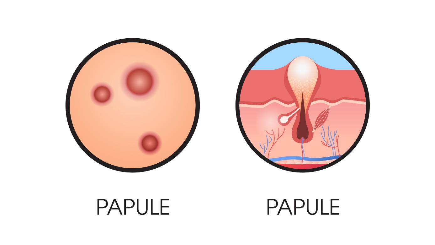 papule sur la peau