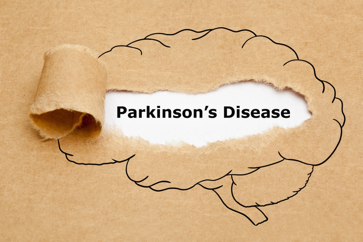 Morbus parkinson = maladie de Parkinson = maladie de Parkinson - animation d'un cerveau avec la maladie de Parkinson au centre