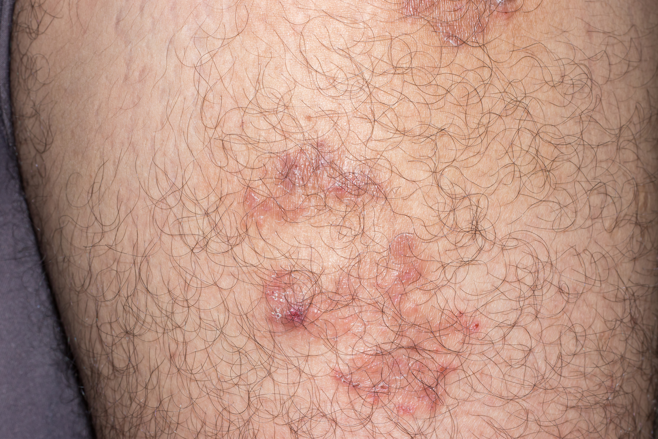 Pemphigus foliacé chez un homme