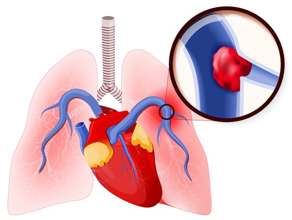 Embolie pulmonaire, fermeture de l'artère pulmonaire par un caillot de sang