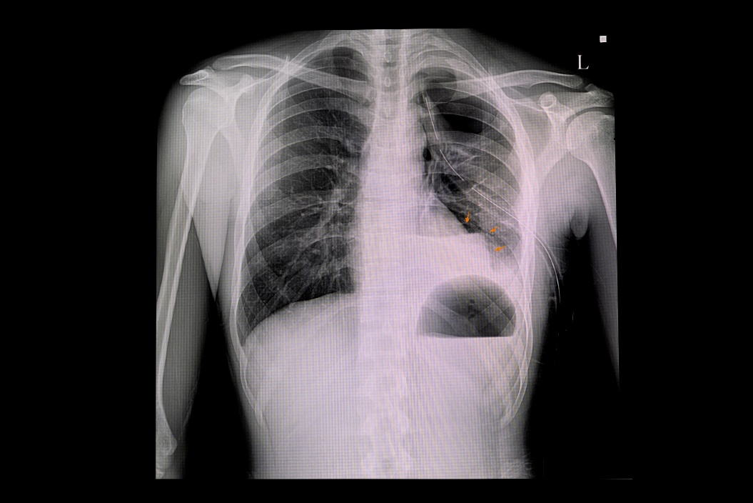 Radiographie d'un pneumothorax du poumon gauche et d'une accumulation d'air dans la cavité pleurale du thorax (couleur blanche)