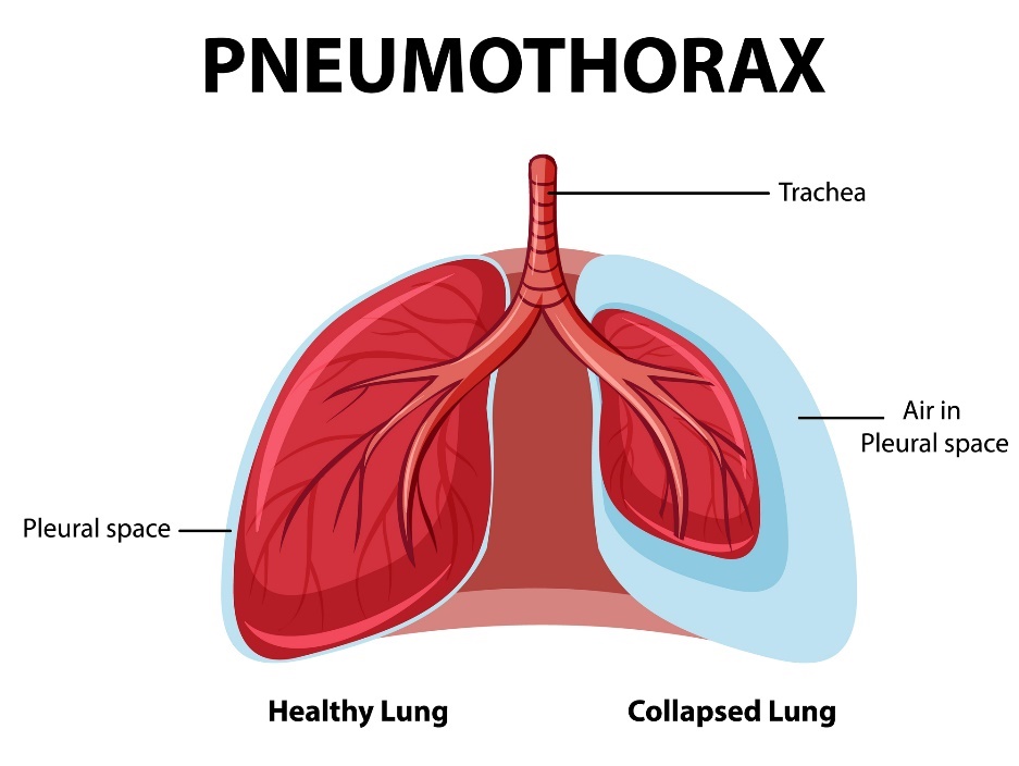 Pneumothorax : poumons sains et affaissés