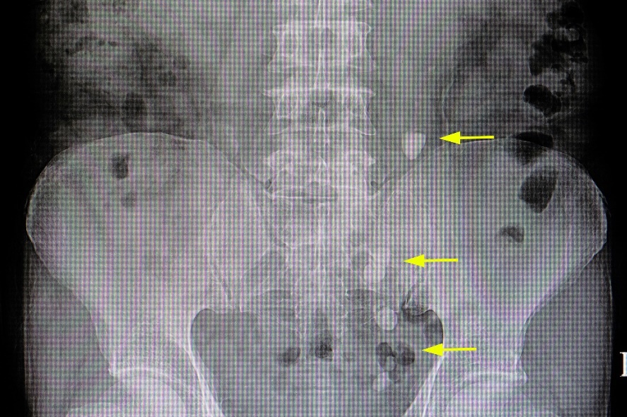 Radiographie : nombreux concrétions dans le parcours des voies urinaires