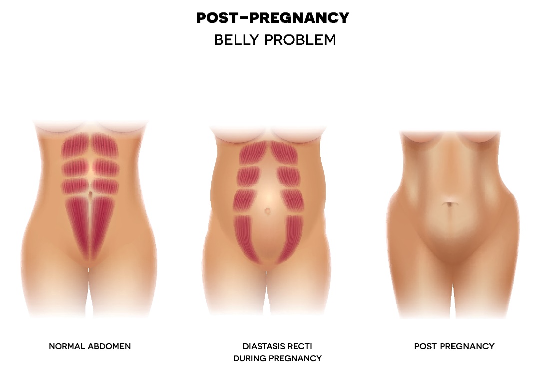 Diastasis post-partum de la paroi abdominale