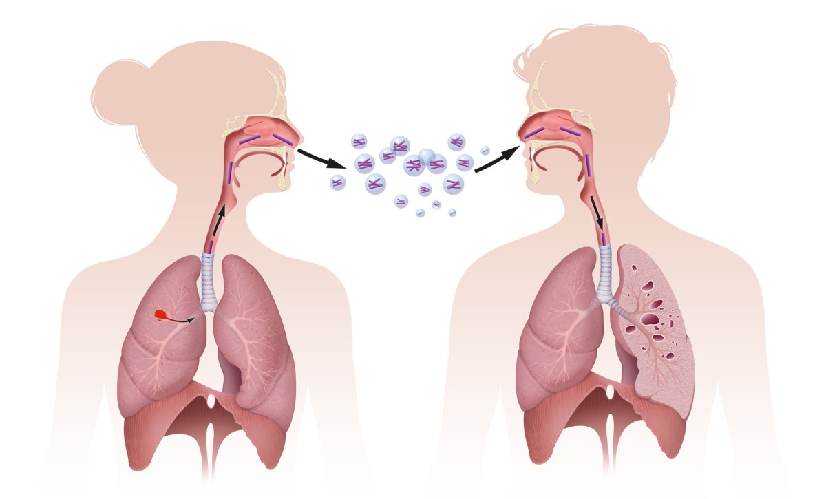 Transmission de la tuberculose par inhalation, c'est-à-dire par inhalation, la figure montre la transmission par inhalation.