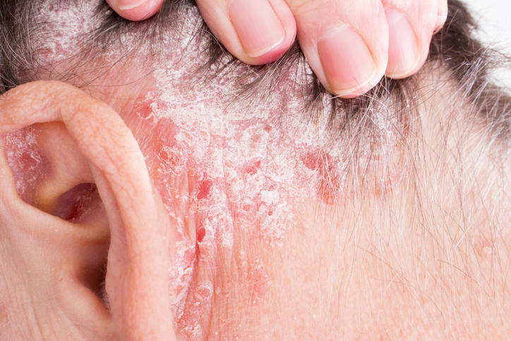 Psoriasis sur la tête, derrière l'oreille et dans les cheveux de la tête