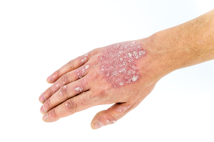 Psoriasis ou psoriasis sur la main, le dos de la main