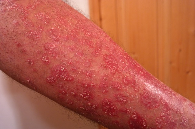 Psoriasis sur le membre supérieur, sur l'avant-bras