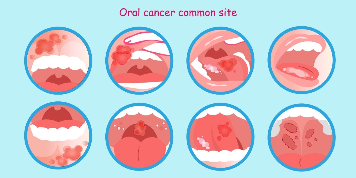 Cancer de la bouche et dépôts tumoraux - un modèle