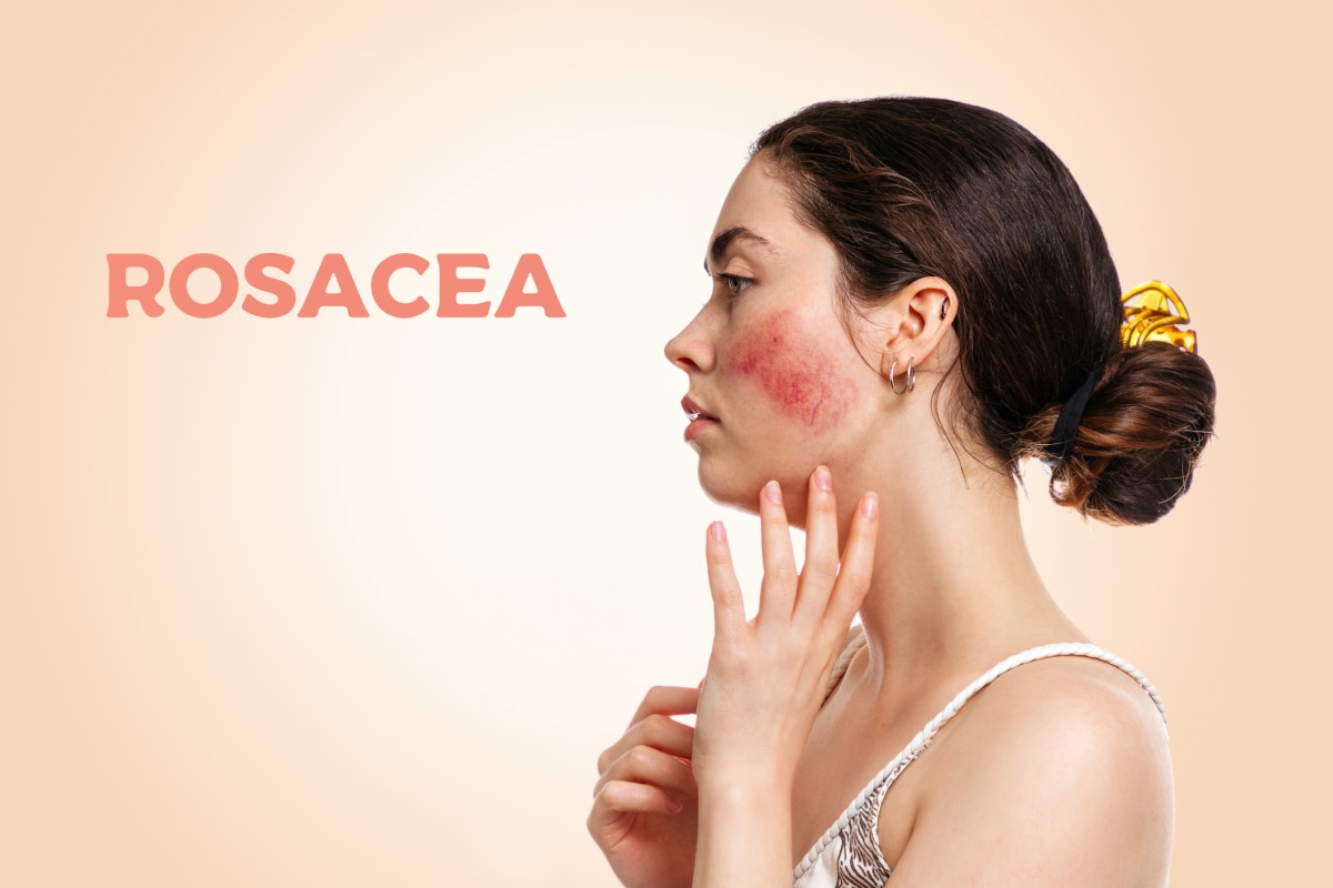 Femme de profil, visage avec rosacée - rosacea