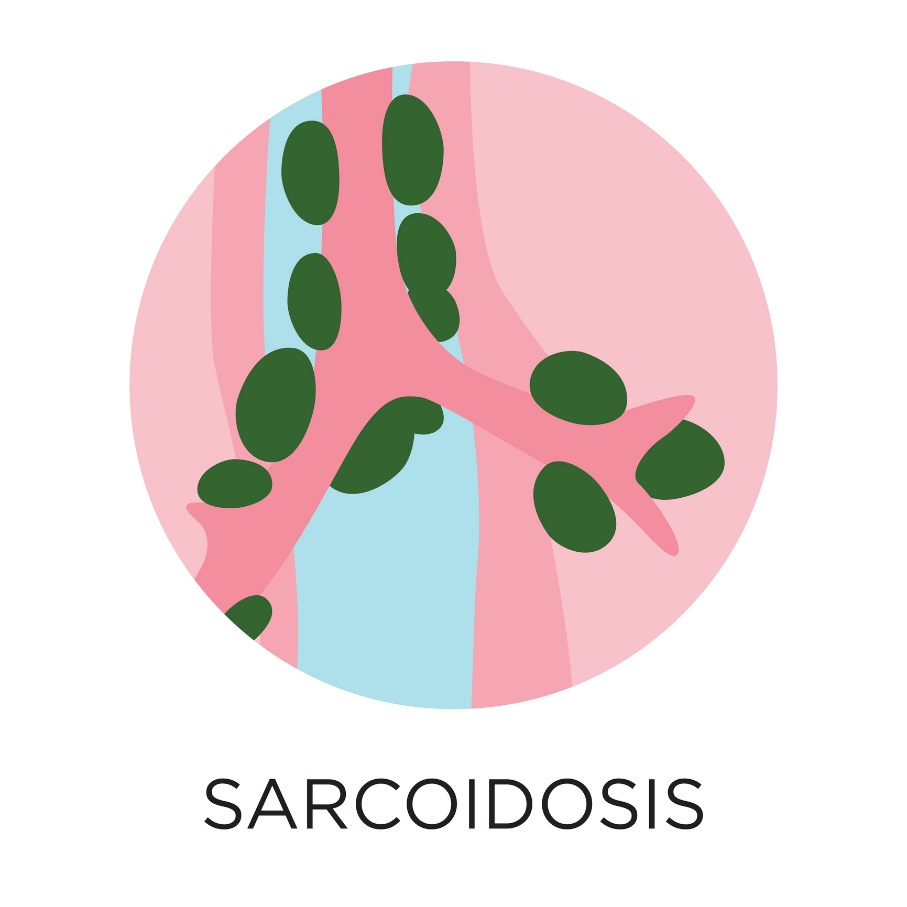 Sarcoïdose - formation de granulomes