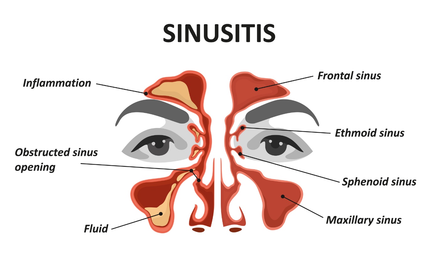 Modèle animé/image de la sinusite et de la sinusite